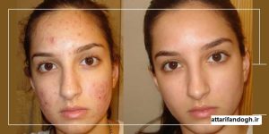 طریقه مصرف سرکه انگبین برای جوش و کبد چرب