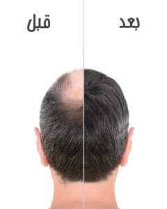 شامپو گیاهی ریزش مو