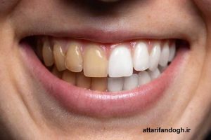 طریقه استفاده جرم گیر گیاهی دندان کیمیا